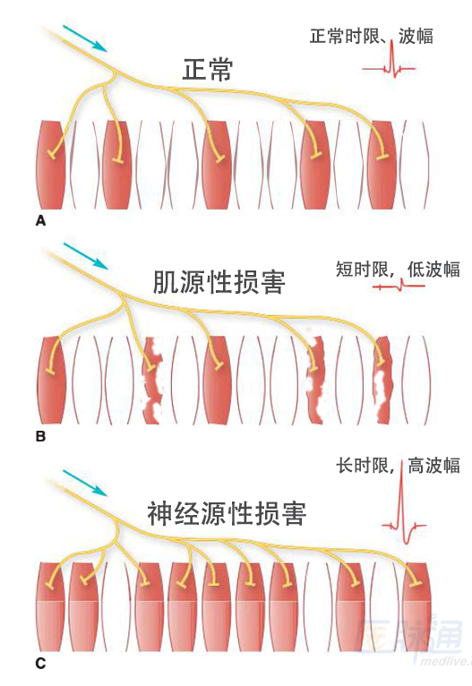 十分钟掌握肌源性改变(肌电图通关第三弹)