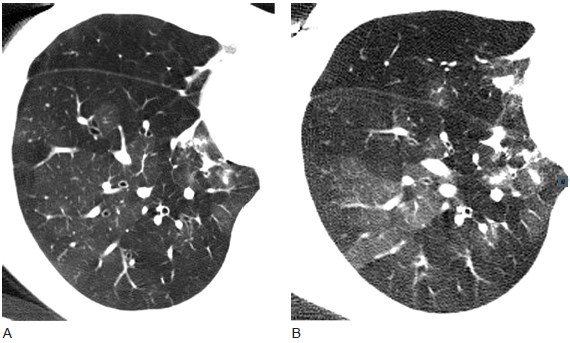 3类细支气管炎的影像学特征(多图)