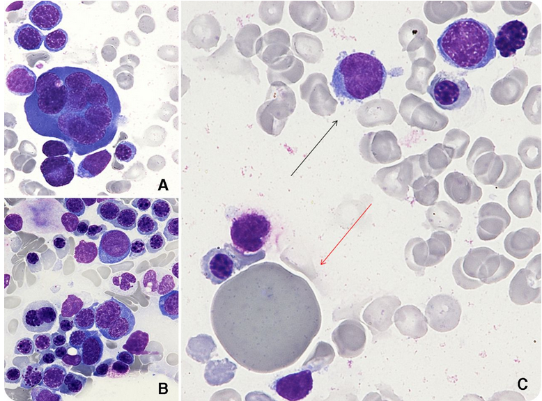 【答案公布】咳嗽、发热疑为何病?