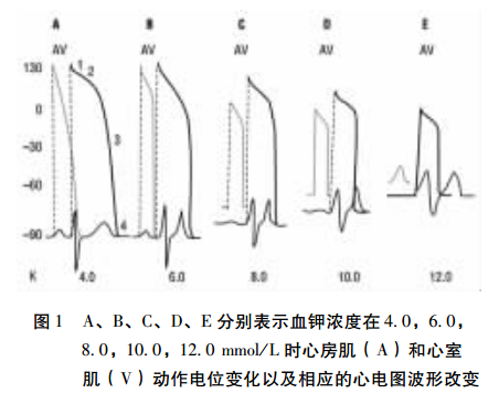 高钾血症:临床关注的心电图问题