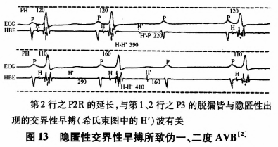 房室传导阻滞心电图诊断需注意的一些问题