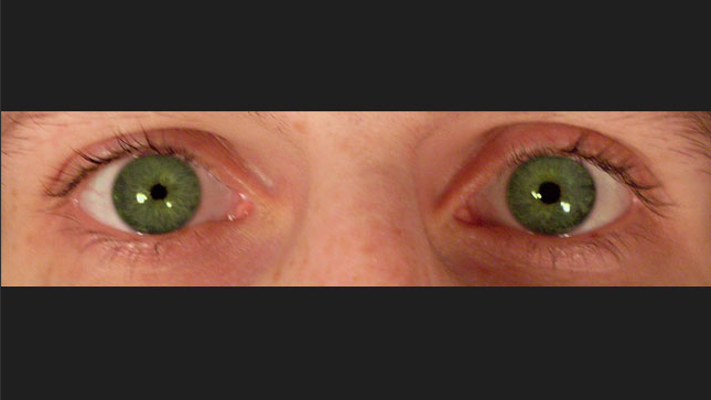 辐辏,调节反射正常,视网膜对光有感受性,具有无眼盲,瞳孔小等特征.