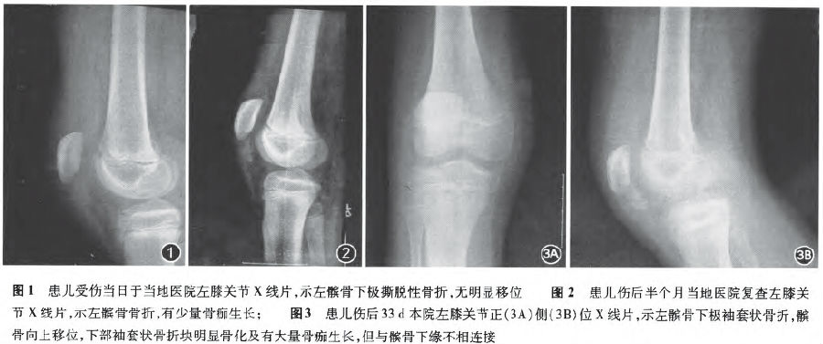 儿童髌骨袖套状骨折误治一例