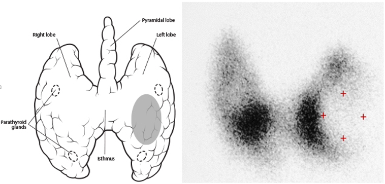 图说甲状腺癌(二)