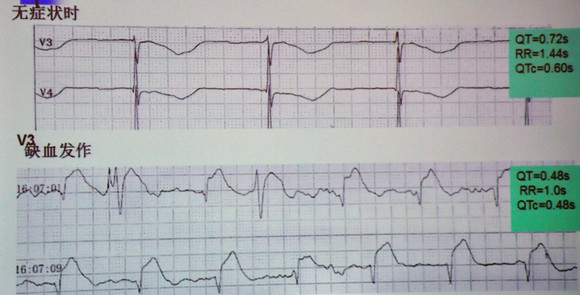 [CMIT2015]临床必备:2小时学看心肌缺血心电图