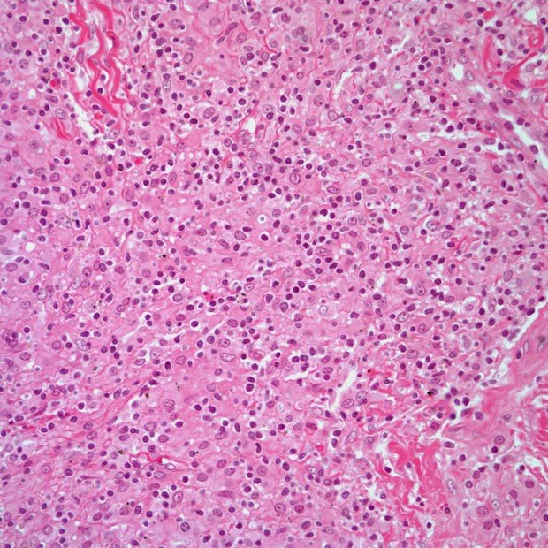 图说 ▍非霍奇金淋巴瘤(下篇)