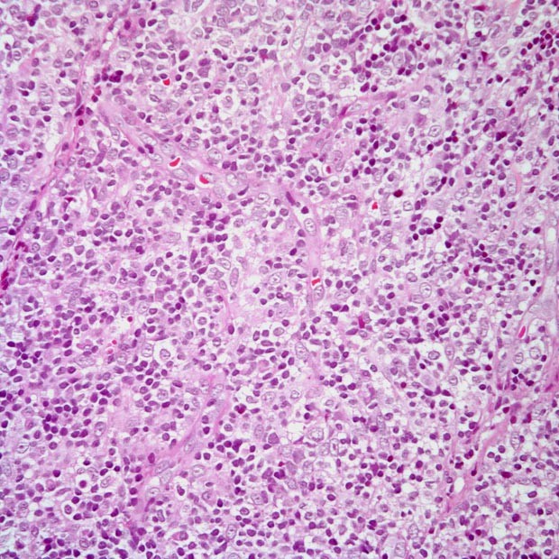 图说 ▍非霍奇金淋巴瘤(下篇)