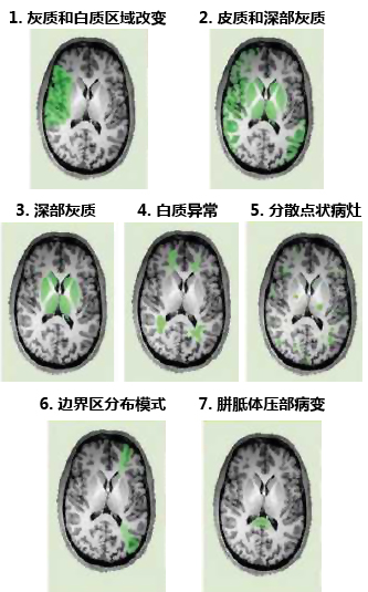 脑卒中影像学鉴别诊断(一):灰质白质改变