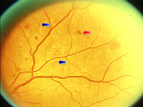 视网膜异常:14种全身性疾病的征象(二)