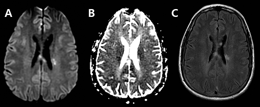 脑卒中影像学鉴别诊断(三):白质异常