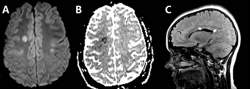 脑卒中影像学鉴别诊断(三):白质异常