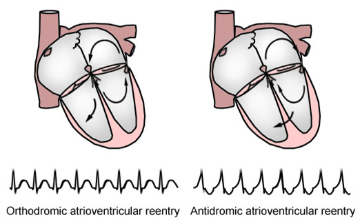 预激综合征:边看图,边答题,边学习(上)
