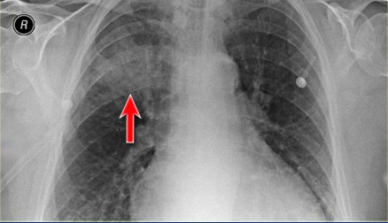 轻松读懂胸片实变(多图)
