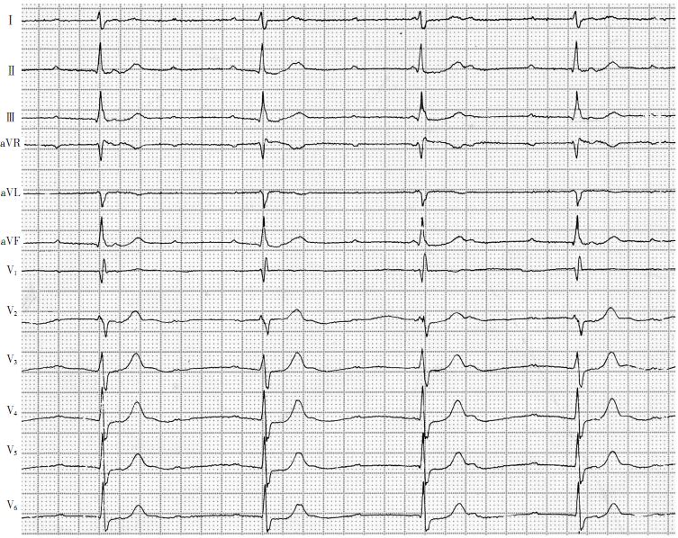 心电图教学查房:三度房室传导阻滞