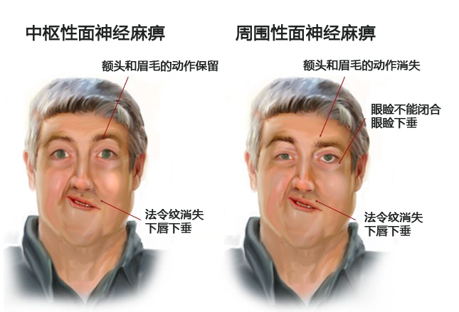 额 纹 鉴别中枢性和周围性面神经麻痹的简单测试是要求患者皱起额纹