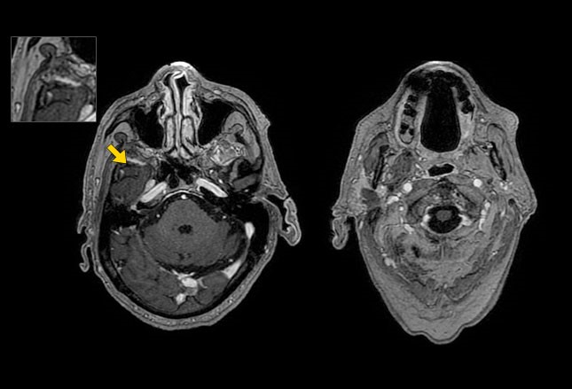 但磁共振成像(mri)可用于排除单侧面神经麻痹的继发原因.