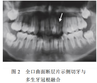 上颌侧切牙与多生牙融合,如何治疗?