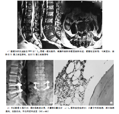 布氏杆菌脊柱炎致马尾综合征1例