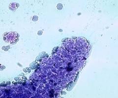 血小板卫星现象对计数的影响