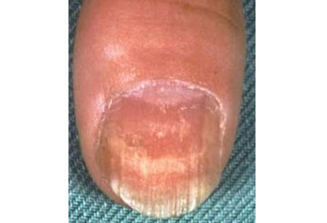 图文并茂:风湿性疾病的皮肤症状之银屑病、白