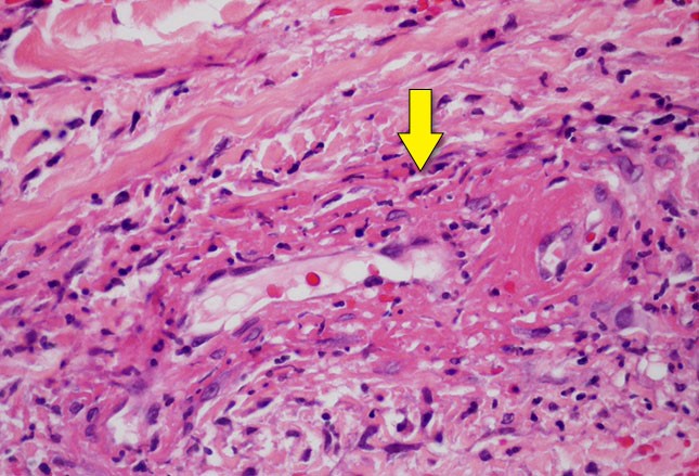图文并茂:风湿性疾病的皮肤症状之银屑病、白