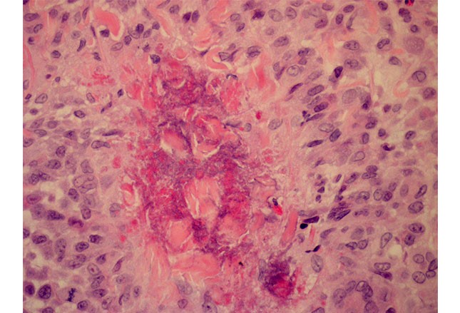 图文并茂:风湿性疾病的皮肤症状之银屑病、白