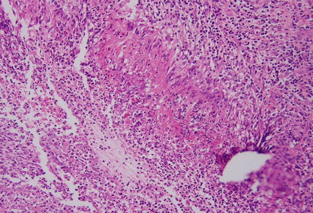 图文并茂:风湿性疾病的皮肤症状之银屑病、白