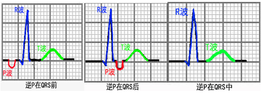 逆行p波