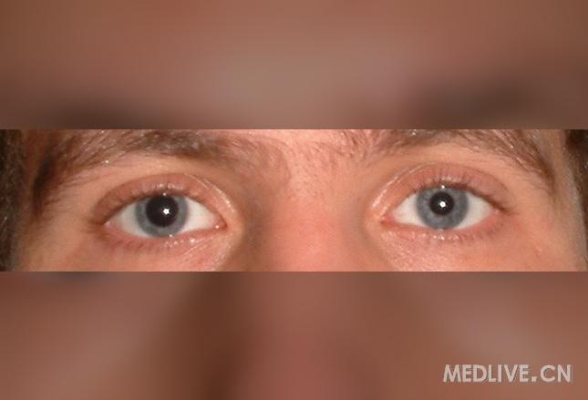 当患者存在意识水平恶化,脑干征(包括瞳孔变化,如下图中的瞳孔不等