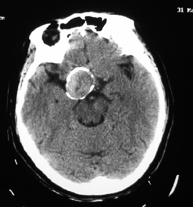 多图|颅内动脉瘤的影像学诊断