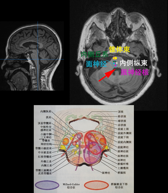 图1 脑桥面神经丘平面的病变包括几个血管综合征,如millard