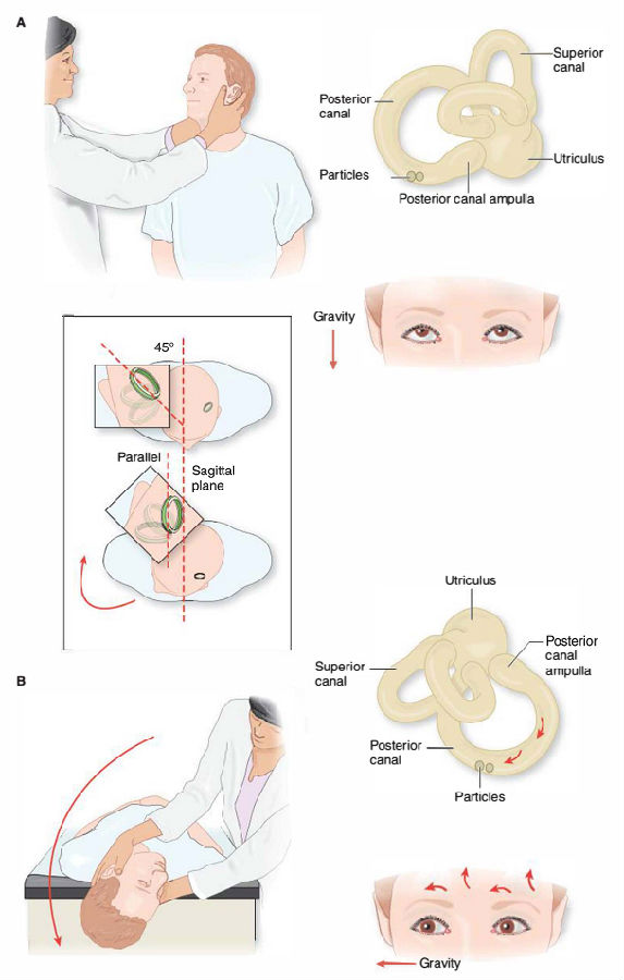 眩晕的主力军——耳石症(bppv)