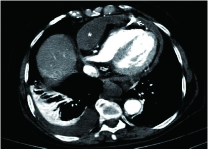 血液透析隧道导管右心室穿孔1例