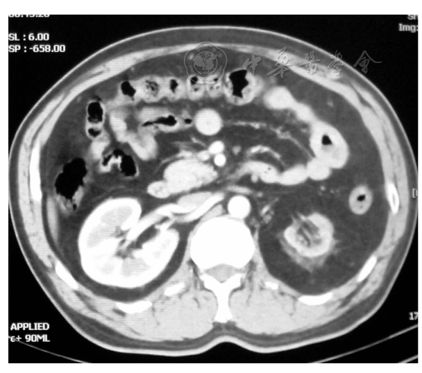 糖尿病肾病CT和MRI成像特点