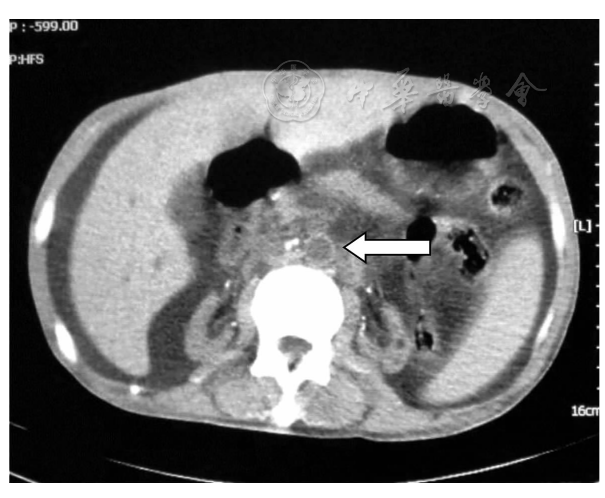 糖尿病肾病CT和MRI成像特点