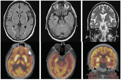 一文详解自身免疫性脑炎的影像学表现