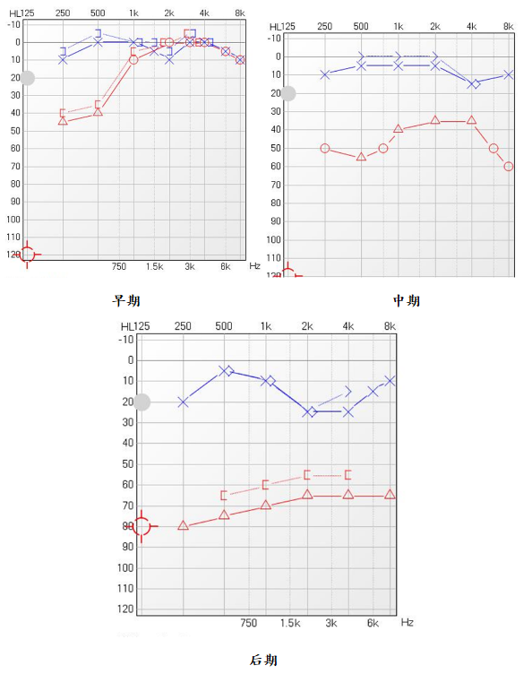 突聋-中高频下降型 ≥2000hz频率听力下降15db以上. 4.