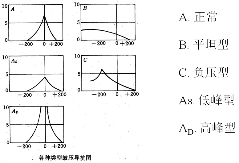 常见鼓室导抗图分型