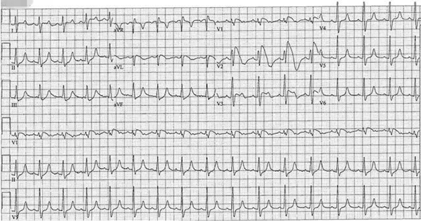 【识图断案】ST段抬高心电图汇总