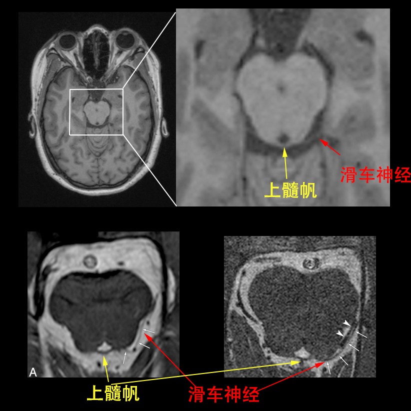神经解剖外传—简单又不简单的滑车神经