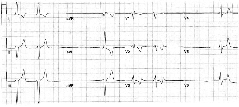 绝佳的伪装者:高钾血症心电图