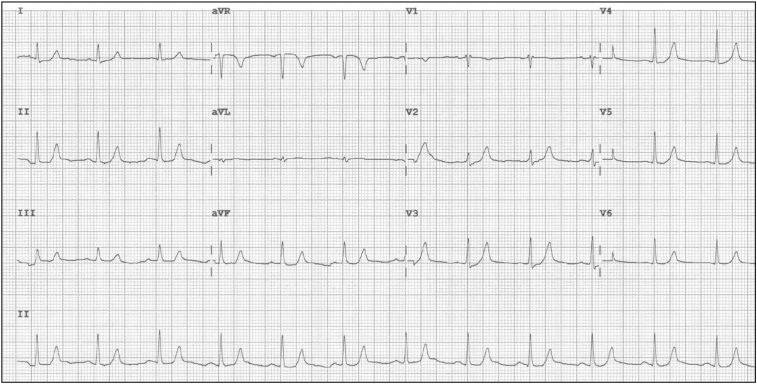 「老刘学图」让人心惊胆寒的高钾血症