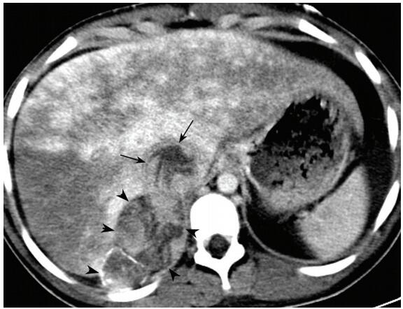哪里来的栓子?检查结果让人惊出一身冷汗