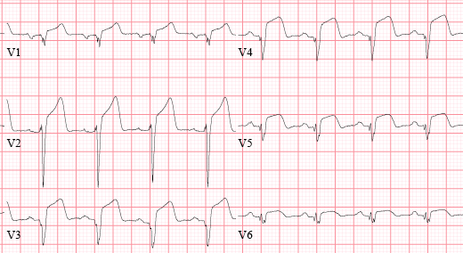 急性心梗的5类心电图表现,每个都值得你铭记在