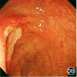 内镜下这些特征可能是艾滋病特征性表现