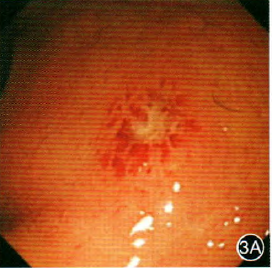 内镜下这些特征可能是艾滋病特征性表现_艾滋