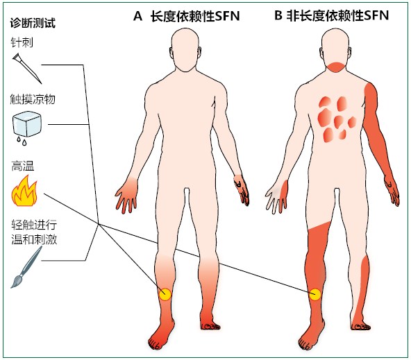 三图两表|快速搞定小纤维神经病的临床表现及