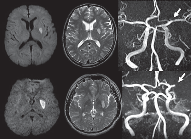 腔隙性脑梗死这个临床诊断,可以慢慢作古了