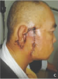 手术方式:全麻下行"右侧腮腺肿物及腮腺全叶切除术 邻位瓣转移修复术"