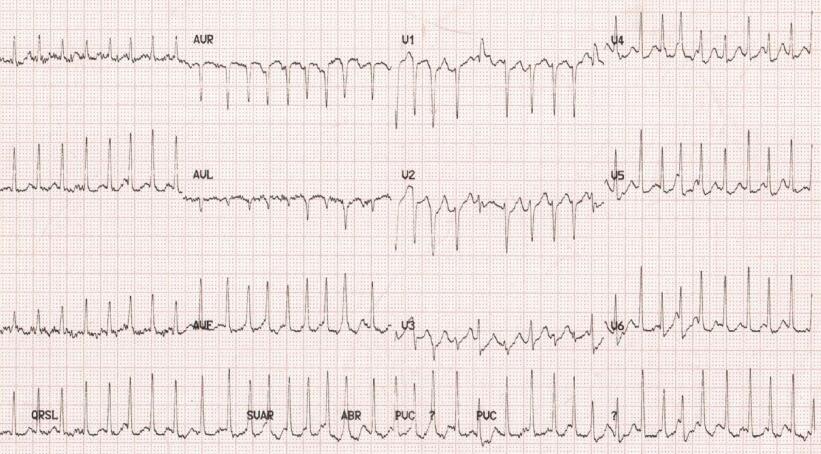 腺苷不能随便推,当心患者颤给你看!